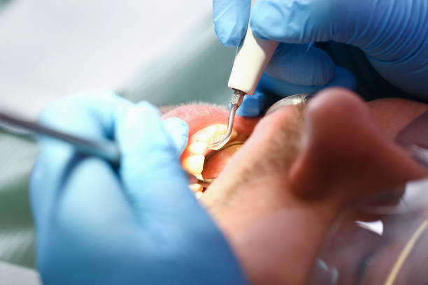 Best Emergency Dental Extractions in Biltmore, TN