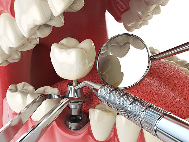 Best Emergency Root Canal Treatment in Biltmore, TN